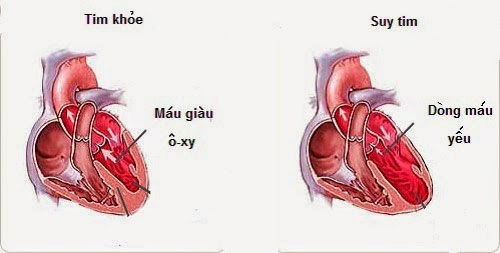 Kế hoạch chăm sóc bệnh nhân suy tim